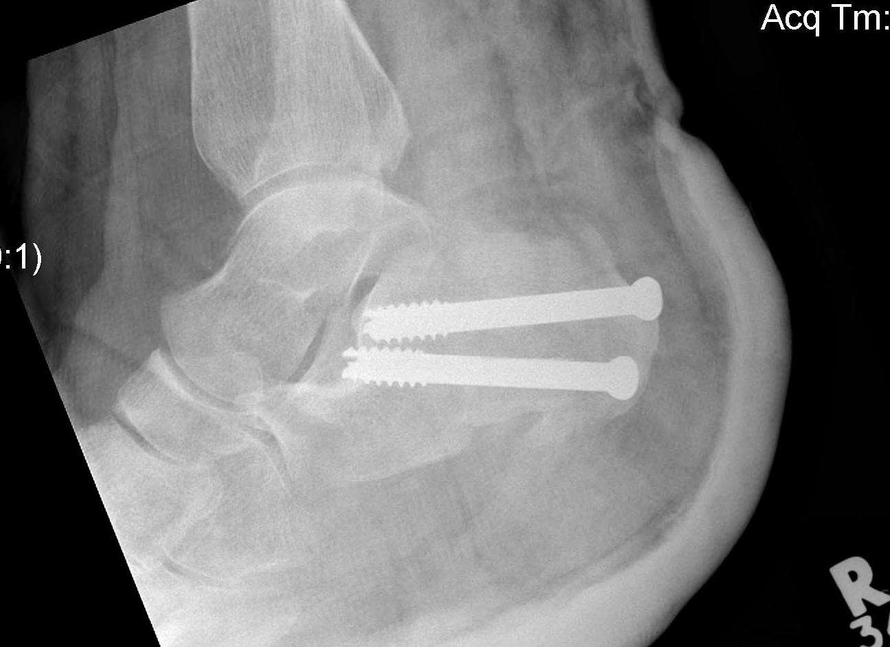 Calcaneal Sliding Osteotomy Lateral